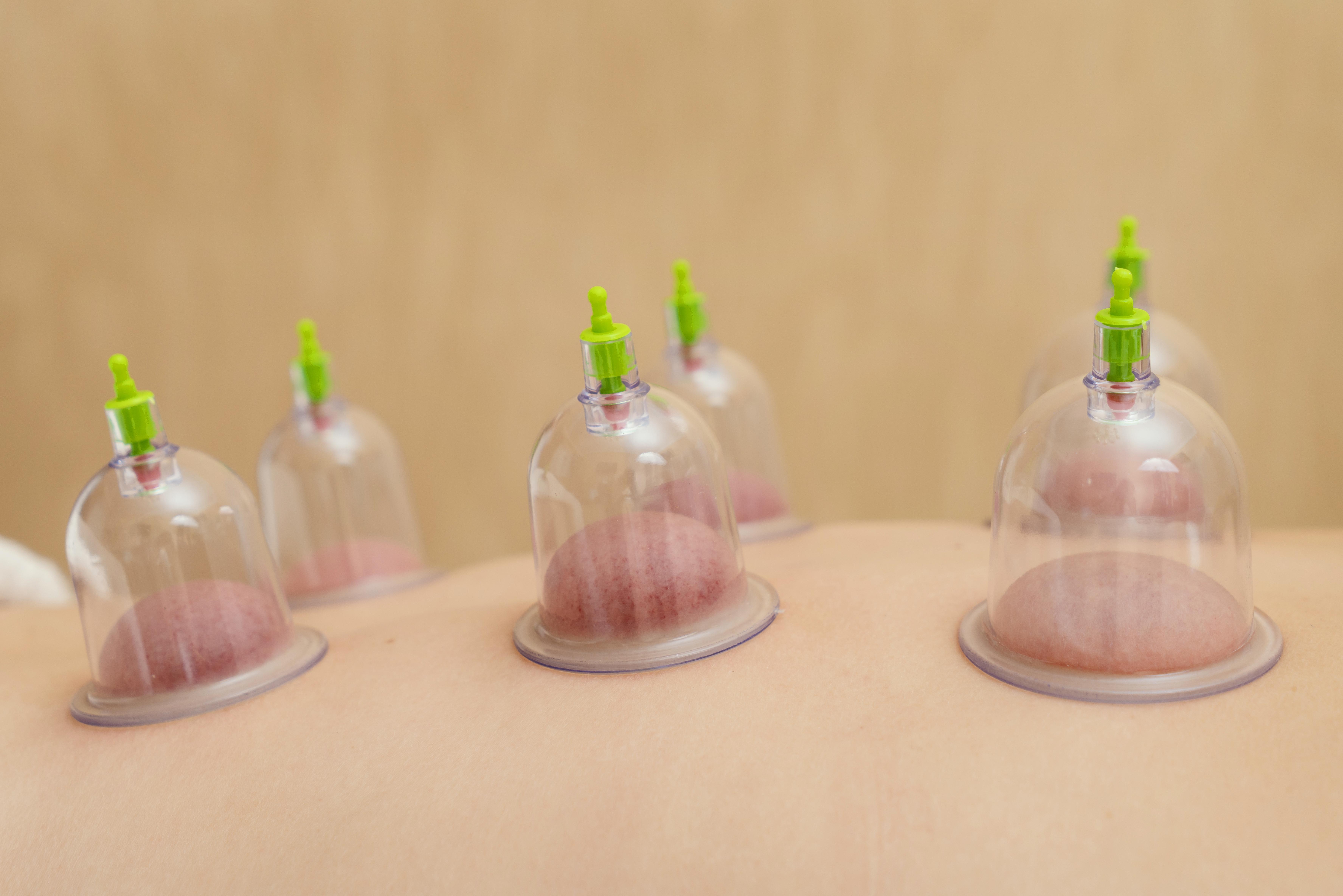 Cupping – en tradisjonell massasjeteknikk med moderne interesse